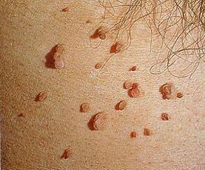 човешки папиломен вирус върху кожата